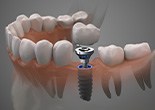 Profile view rendering of single dental implant in lower translucent jaw with gray background