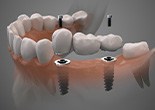 Profile view rendering of implant bridge in lower translucent jaw with gray background