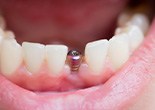 Dental implant post in gum