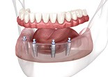 Illustration of full set of lower dentures anchoring to implants in transparent jaw with white background