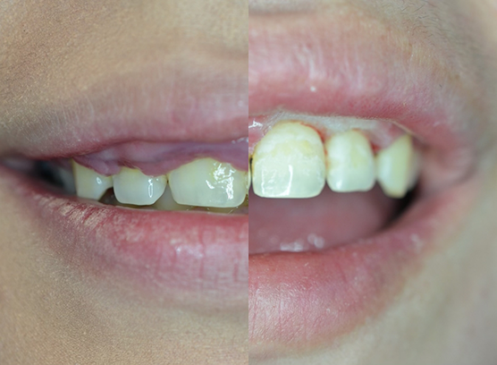 Before and after gum recontouring