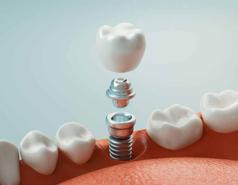 A computer rendering of a dental implant.